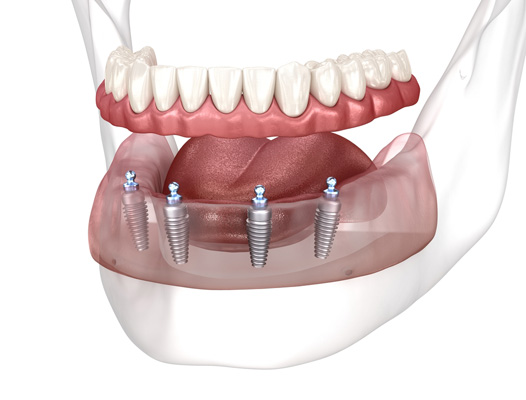 The Benefits Of All On   Implants From A Periodontist