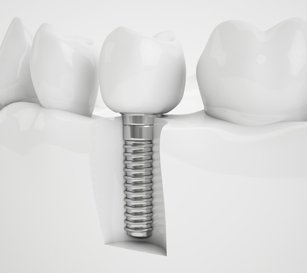 Mansfield Dental Implants
